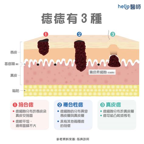 痣長毛原因|痣變大、痣多或長毛會變皮膚癌？認識痣的形成。